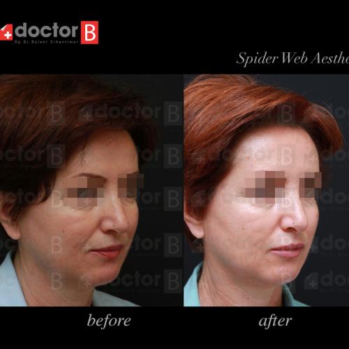 صور قبل وبعد لمرضانا - الجراحة التجميلية - د. مرفة أوفلاز